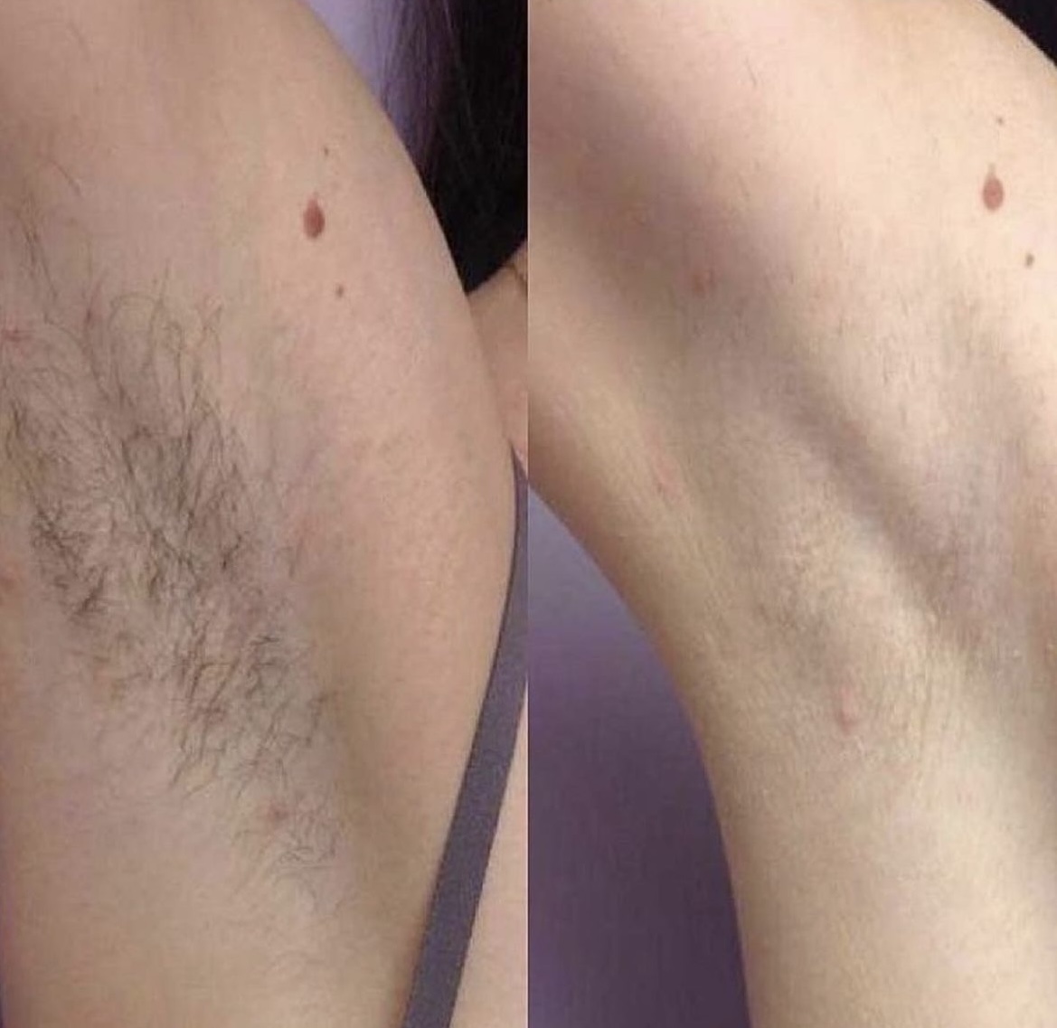 Is diode laser hair removal better than IPL?