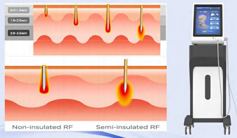 How many years does microneedling take off your face?